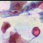 Πινακοθήκη - Δυσπλασίες τραχήλου μήτρας σοβαρού βαθμού II